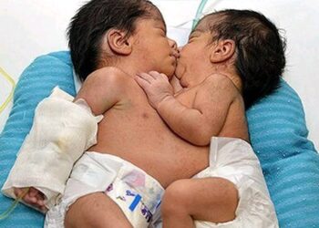 جدا سازی موفقیت آمیز دوقلوهای بهم چسبیده