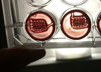 ترمیم استخوان های شکسته با خون بیمار!