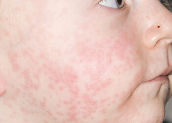 زنگ خطر شیوع سرخک در دزفول به صدا درآمد