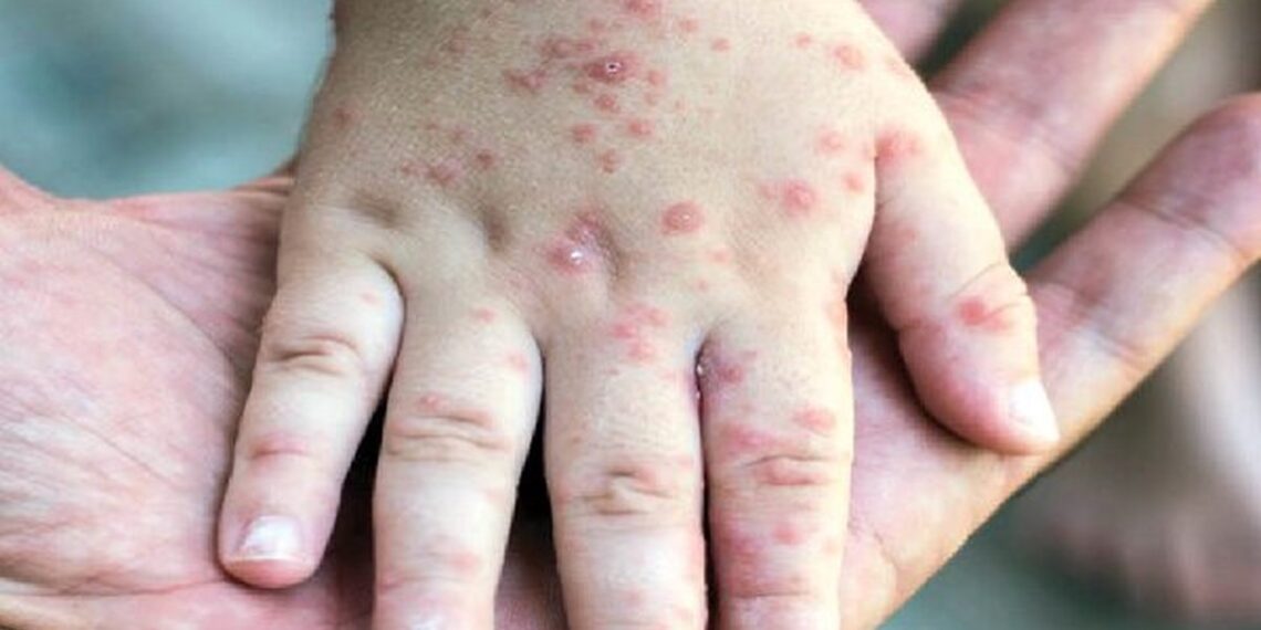 افزایش موارد مشکوک به سرخک در دزفول