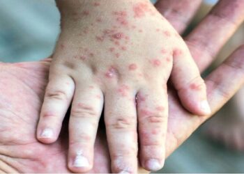 افزایش موارد مشکوک به سرخک در دزفول