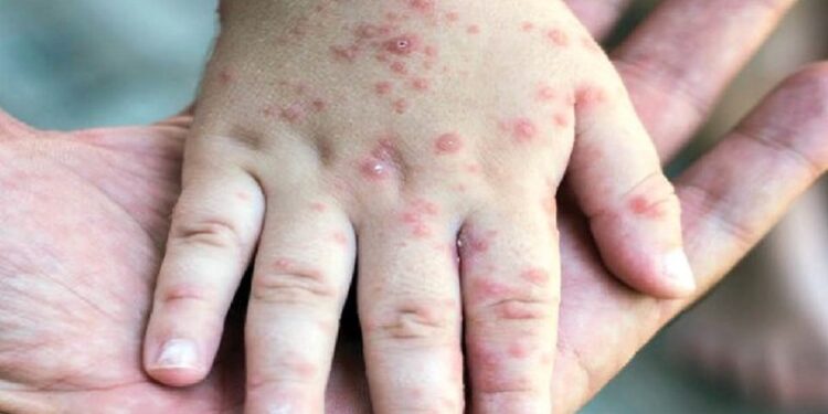 افزایش موارد مشکوک به سرخک در دزفول